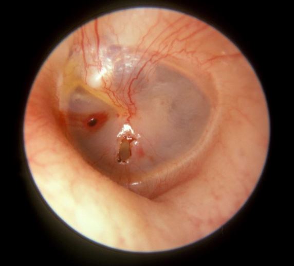 Monday Morning Medical: Blown Ear Drum